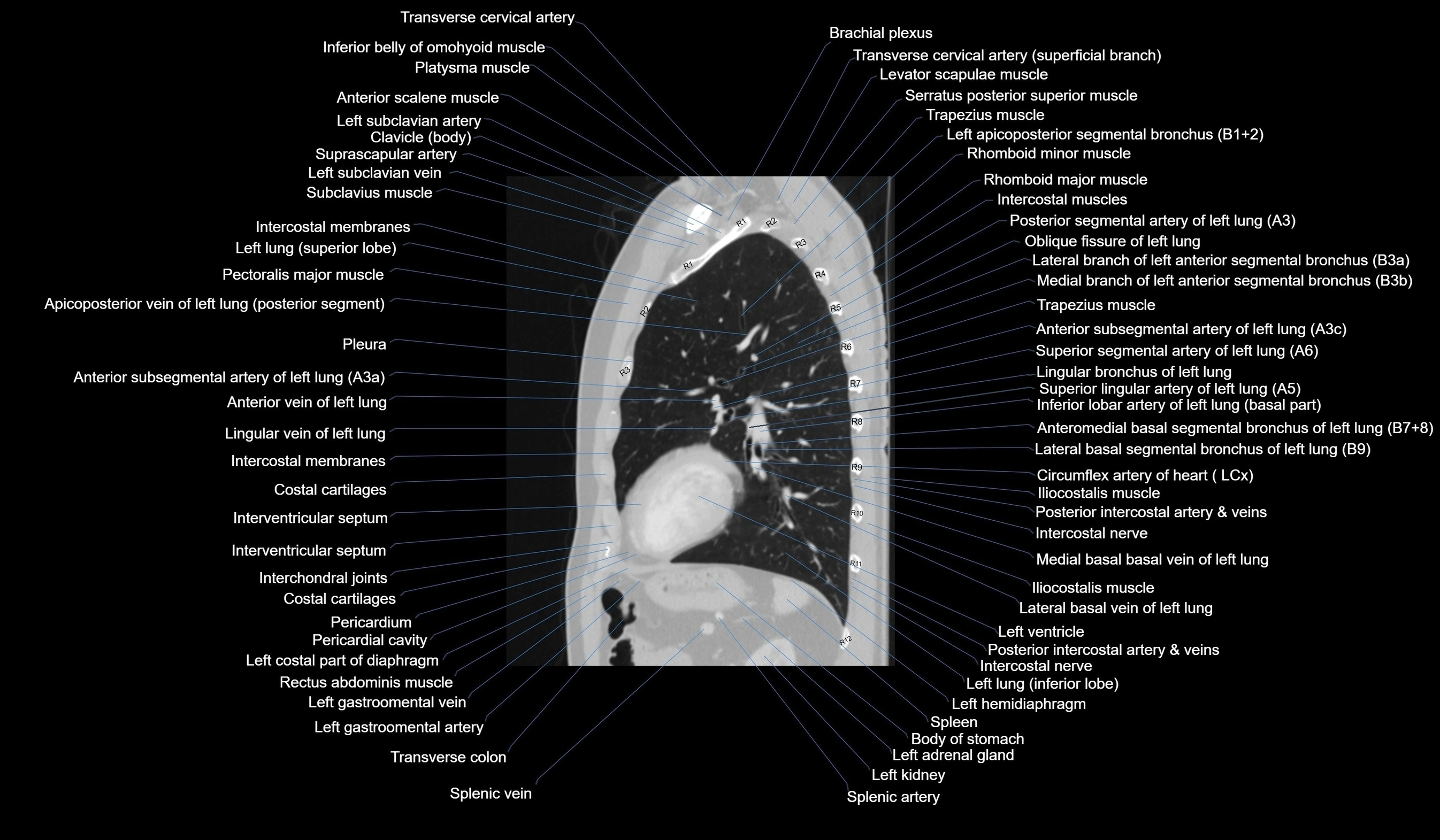 CT chest (thorax) labelled sagittal cross sectional anatomy radiology image-00098.webp